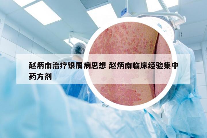 赵炳南治疗银屑病思想 赵炳南临床经验集中药方剂