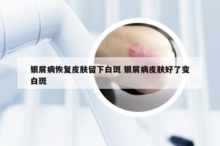 银屑病恢复皮肤留下白斑 银屑病皮肤好了变白斑