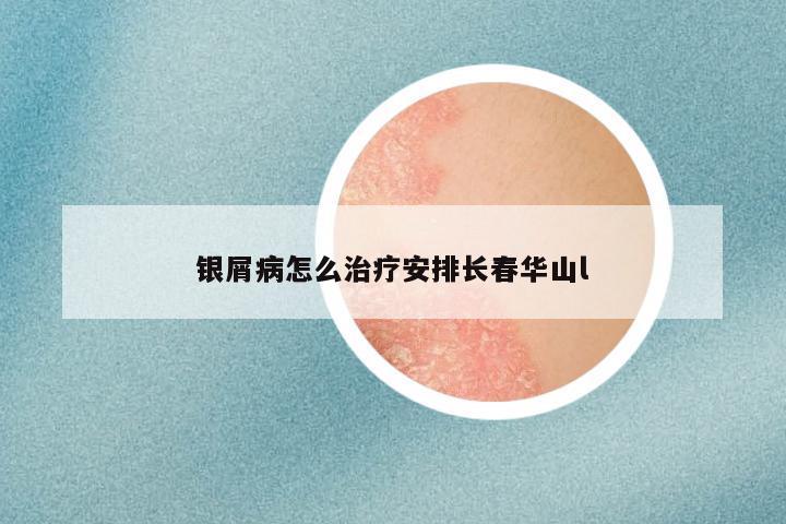 银屑病怎么治疗安排长春华山l