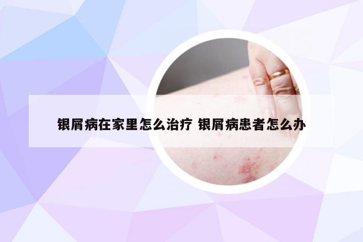 银屑病在家里怎么治疗 银屑病患者怎么办