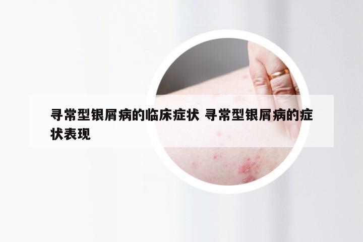 寻常型银屑病的临床症状 寻常型银屑病的症状表现