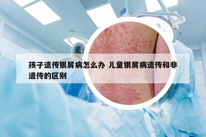 孩子遗传银屑病怎么办 儿童银屑病遗传和非遗传的区别