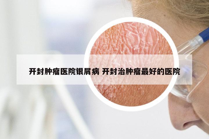 开封肿瘤医院银屑病 开封治肿瘤最好的医院