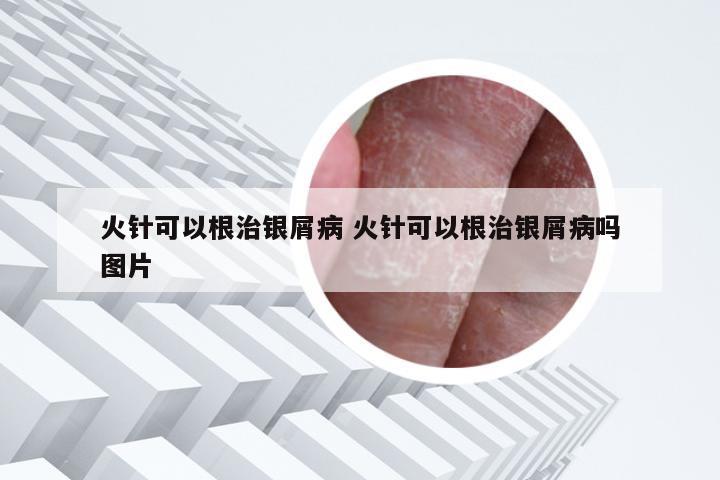 火针可以根治银屑病 火针可以根治银屑病吗图片