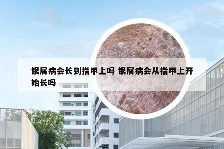 银屑病会长到指甲上吗 银屑病会从指甲上开始长吗