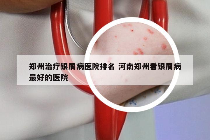 郑州治疗银屑病医院排名 河南郑州看银屑病最好的医院