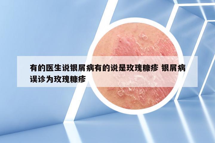 有的医生说银屑病有的说是玫瑰糠疹 银屑病误诊为玫瑰糠疹