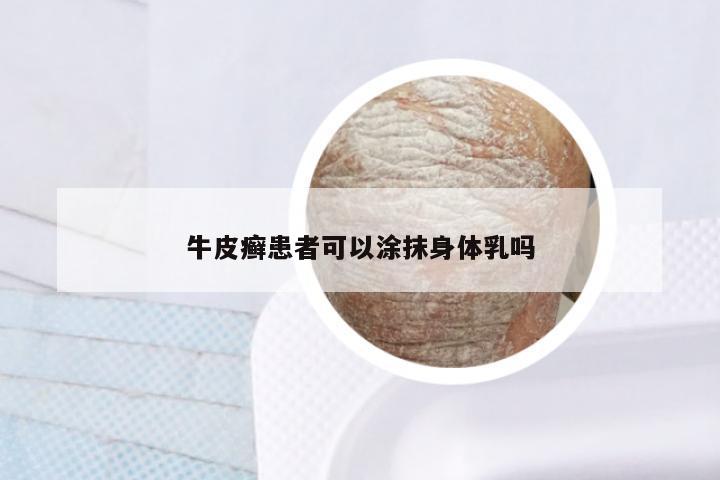 牛皮癣患者可以涂抹身体乳吗