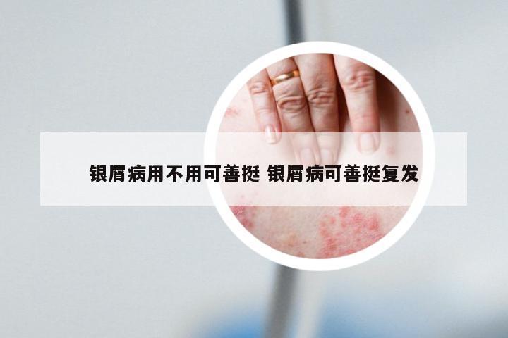 银屑病用不用可善挺 银屑病可善挺复发
