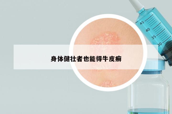身体健壮者也能得牛皮癣