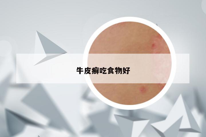 牛皮癣吃食物好
