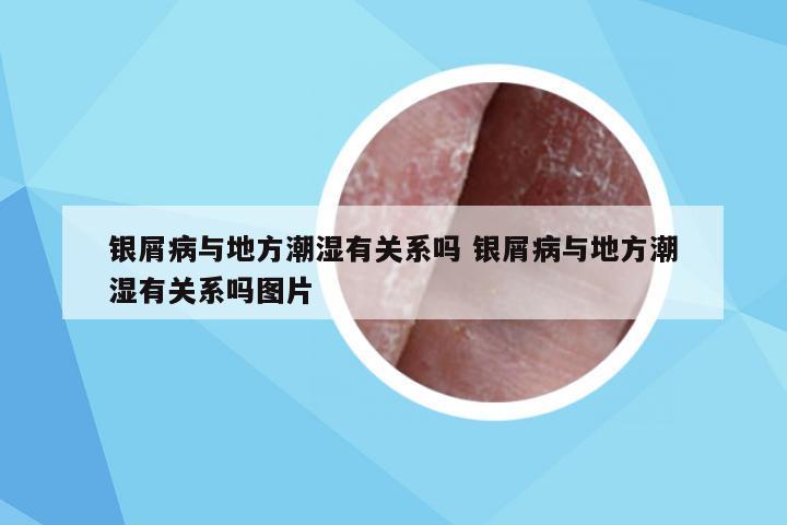银屑病与地方潮湿有关系吗 银屑病与地方潮湿有关系吗图片