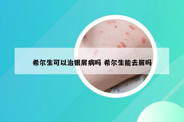 希尔生可以治银屑病吗 希尔生能去屑吗