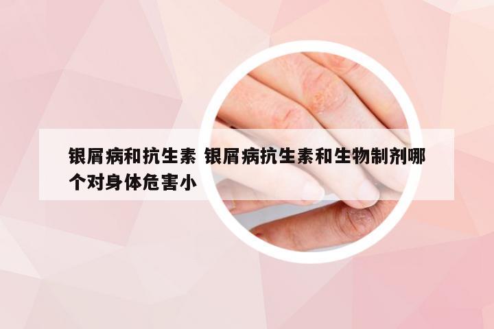 银屑病和抗生素 银屑病抗生素和生物制剂哪个对身体危害小