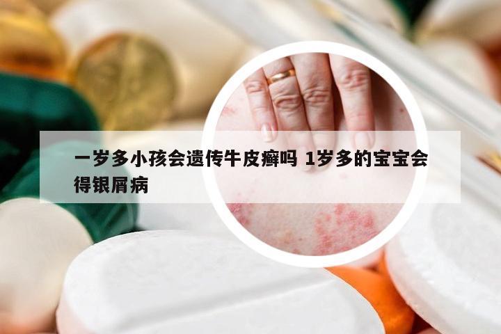 一岁多小孩会遗传牛皮癣吗 1岁多的宝宝会得银屑病