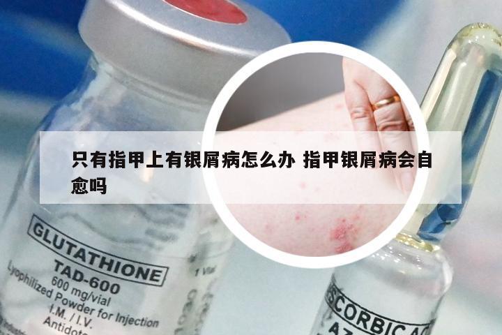 只有指甲上有银屑病怎么办 指甲银屑病会自愈吗