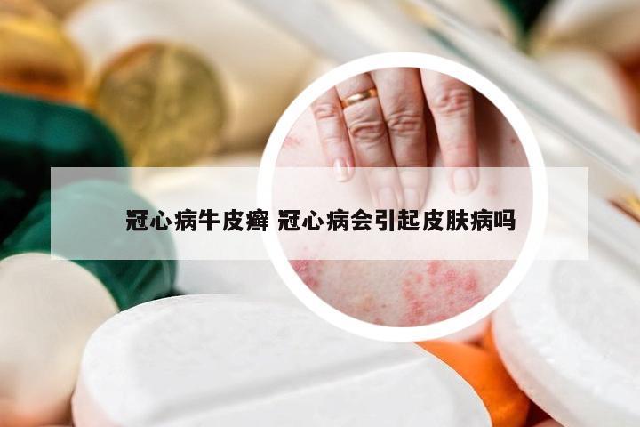 冠心病牛皮癣 冠心病会引起皮肤病吗