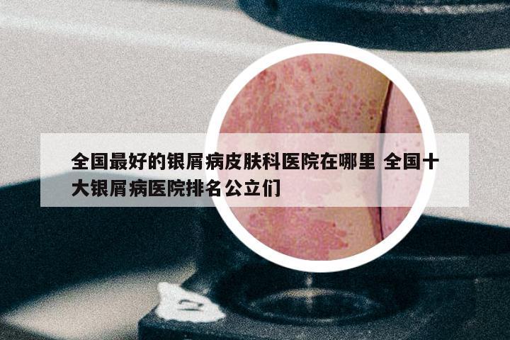 全国最好的银屑病皮肤科医院在哪里 全国十大银屑病医院排名公立们