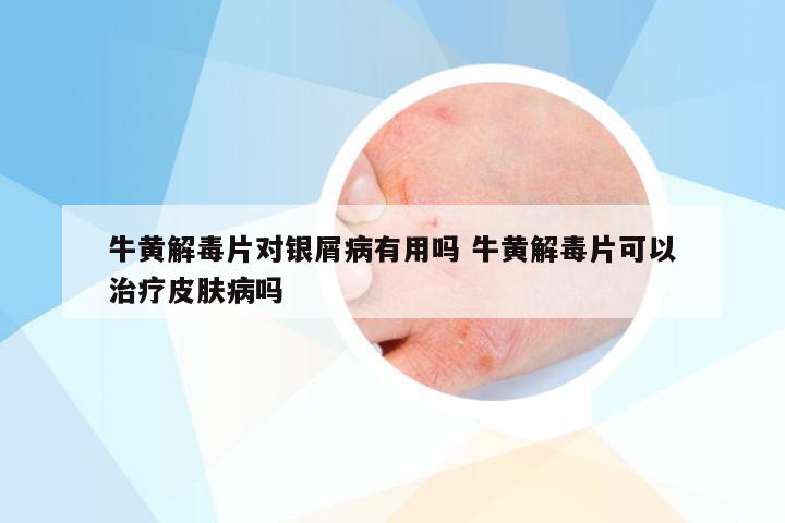牛黄解毒片对银屑病有用吗 牛黄解毒片可以治疗皮肤病吗