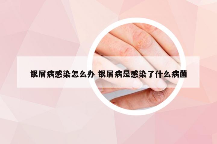 银屑病感染怎么办 银屑病是感染了什么病菌
