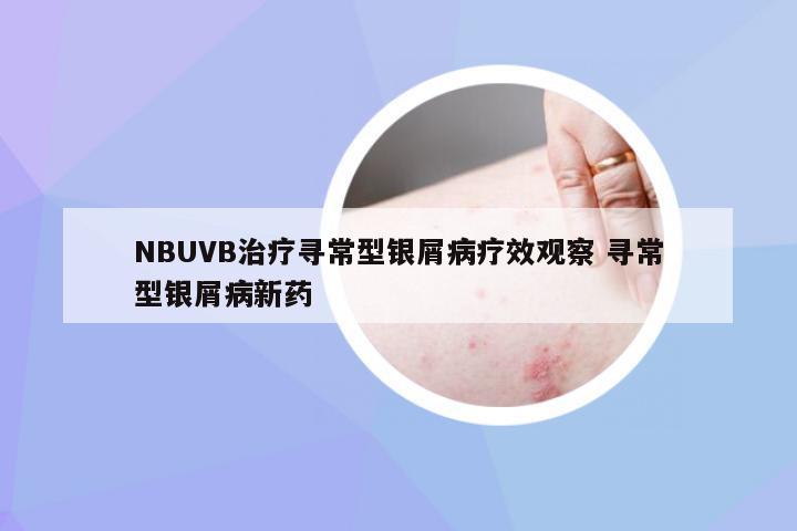 NBUVB治疗寻常型银屑病疗效观察 寻常型银屑病新药
