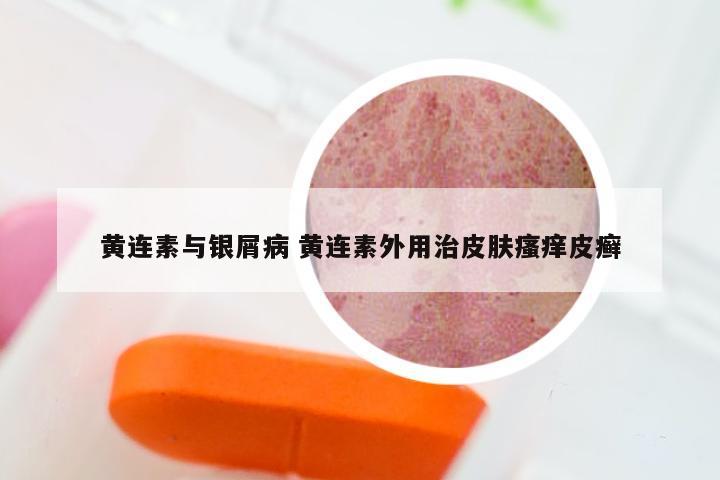 黄连素与银屑病 黄连素外用治皮肤瘙痒皮癣