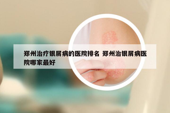郑州治疗银屑病的医院排名 郑州治银屑病医院哪家最好