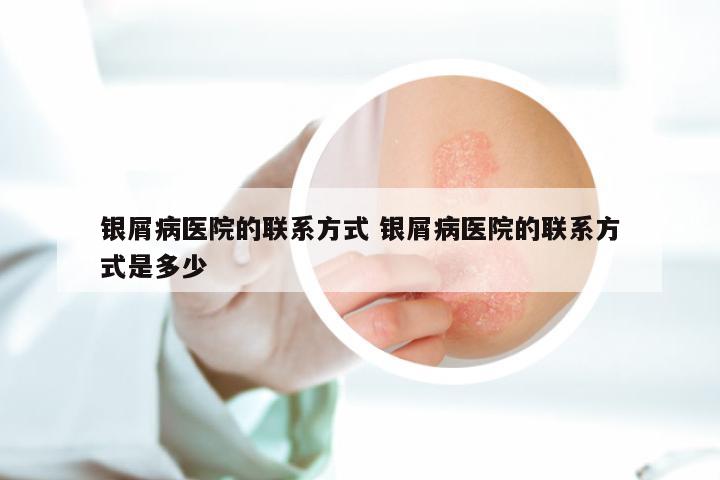 银屑病医院的联系方式 银屑病医院的联系方式是多少
