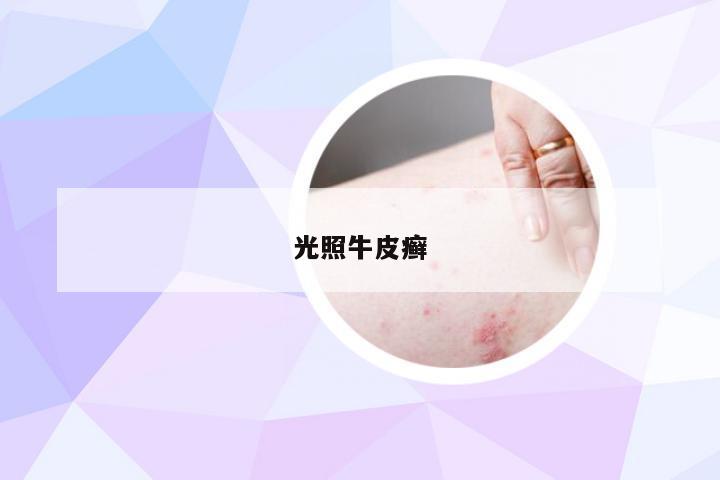 光照牛皮癣