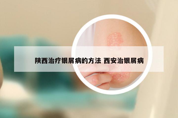 陕西治疗银屑病的方法 西安治银屑病