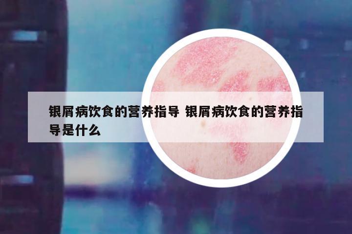 银屑病饮食的营养指导 银屑病饮食的营养指导是什么