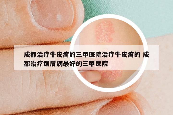 成都治疗牛皮癣的三甲医院治疗牛皮癣的 成都治疗银屑病最好的三甲医院
