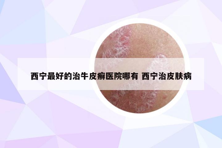 西宁最好的治牛皮癣医院哪有 西宁治皮肤病