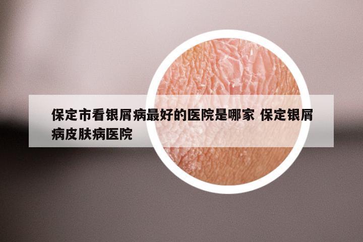 保定市看银屑病最好的医院是哪家 保定银屑病皮肤病医院
