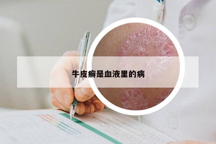 牛皮癣是血液里的病