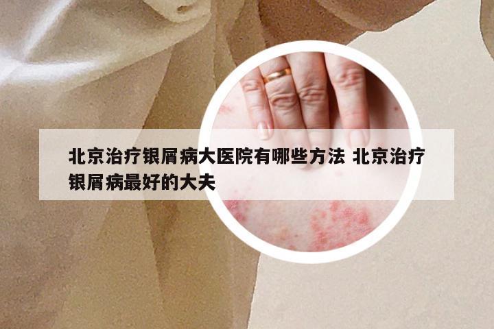 北京治疗银屑病大医院有哪些方法 北京治疗银屑病最好的大夫