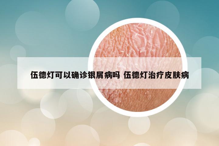 伍德灯可以确诊银屑病吗 伍德灯治疗皮肤病