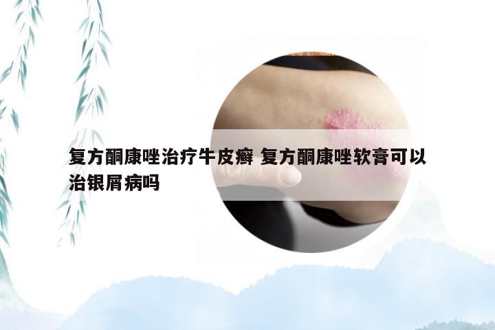 复方酮康唑治疗牛皮癣 复方酮康唑软膏可以治银屑病吗