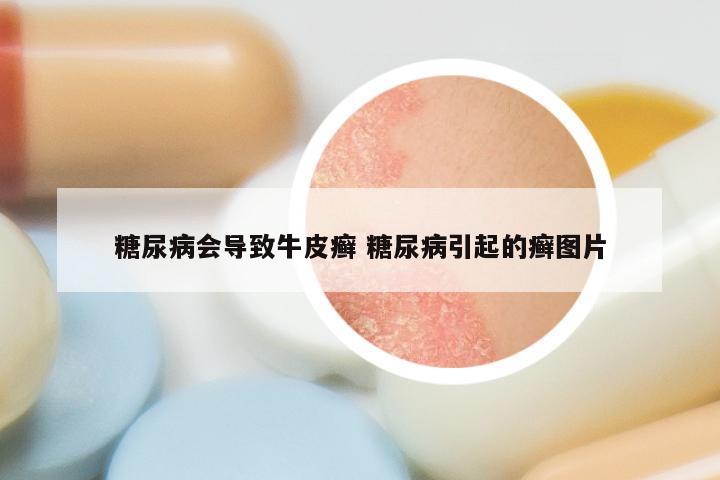 糖尿病会导致牛皮癣 糖尿病引起的癣图片