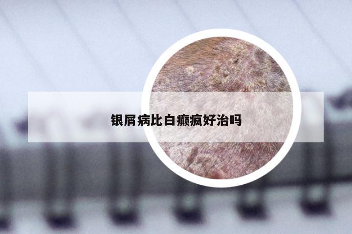 银屑病比白癫疯好治吗