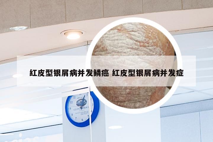 红皮型银屑病并发鳞癌 红皮型银屑病并发症