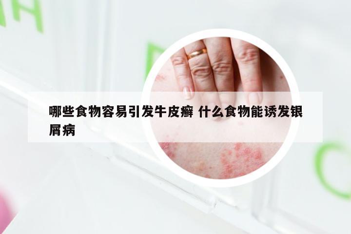哪些食物容易引发牛皮癣 什么食物能诱发银屑病
