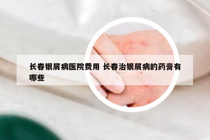长春银屑病医院费用 长春治银屑病的药膏有哪些