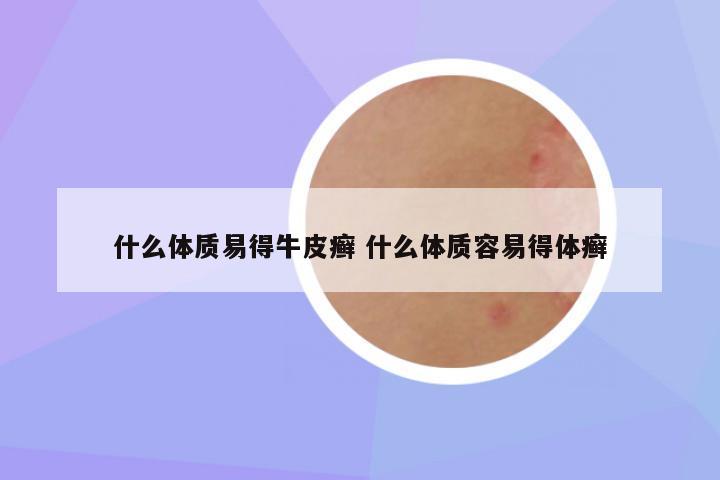 什么体质易得牛皮癣 什么体质容易得体癣