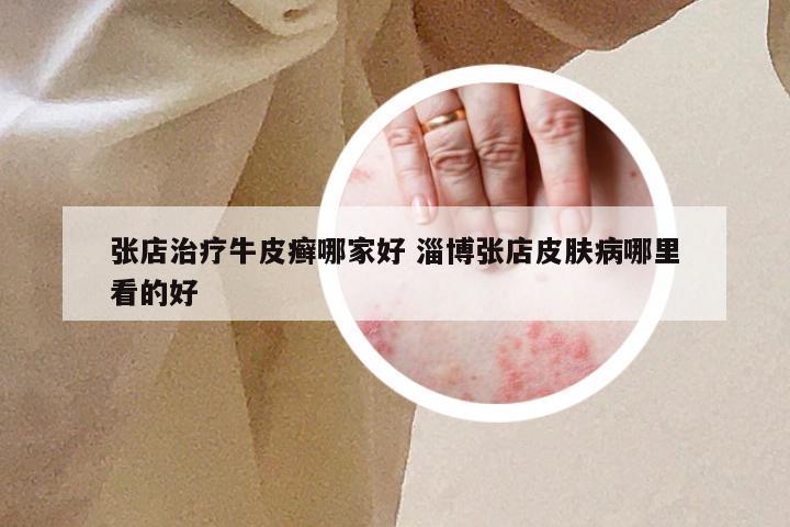 张店治疗牛皮癣哪家好 淄博张店皮肤病哪里看的好