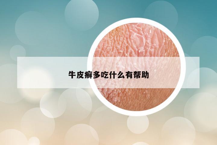 牛皮癣多吃什么有帮助