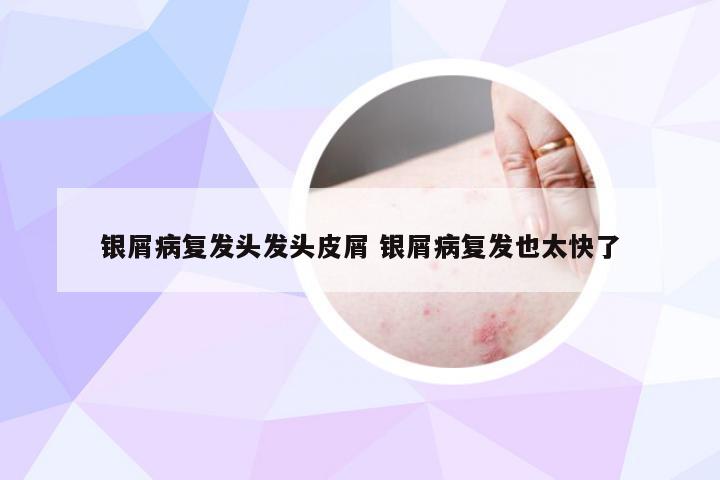 银屑病复发头发头皮屑 银屑病复发也太快了