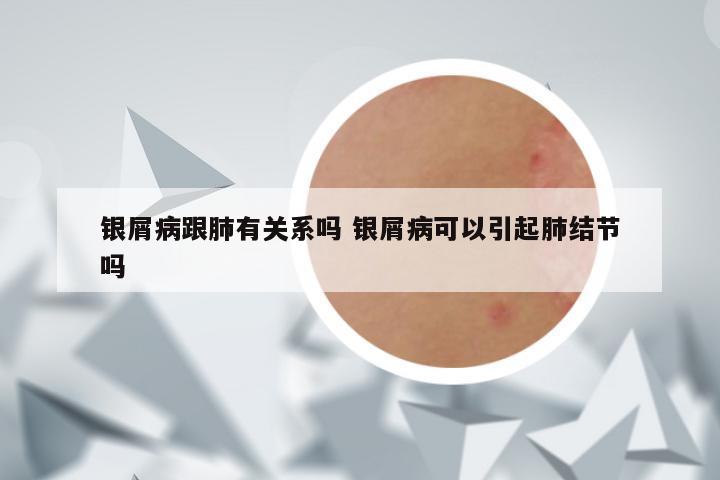 银屑病跟肺有关系吗 银屑病可以引起肺结节吗