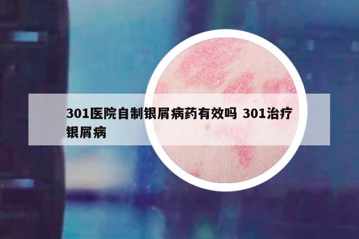 301医院自制银屑病药有效吗 301治疗银屑病