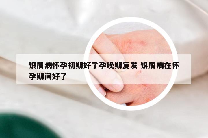银屑病怀孕初期好了孕晚期复发 银屑病在怀孕期间好了